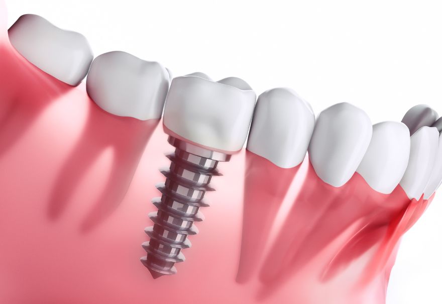 Implantes Dentários